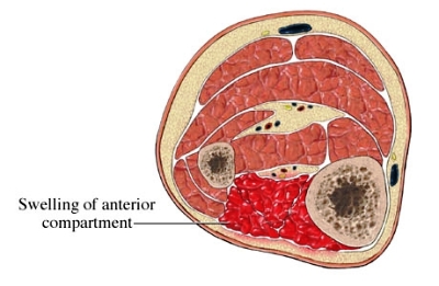 exerciseinducedcompartmentsyndrome